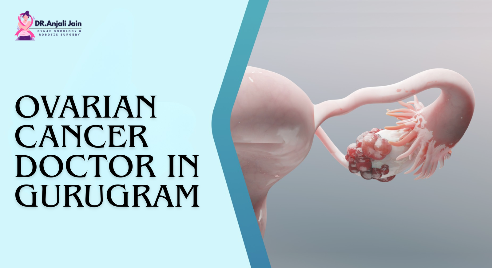Ovarian Cancer Doctor In Gurugram |